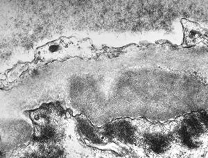 M,53y. | type III membranoproliferative glomerulonephritis M,53y. | type III membranoproliferative glomerulonephritis